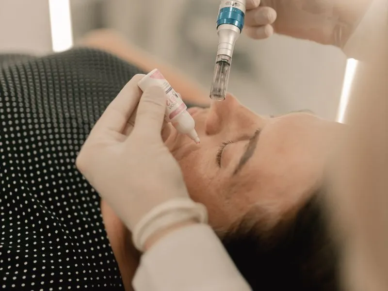 Microneedling treatment at Regener8 Aesthetics, Selly Oak Birmingham